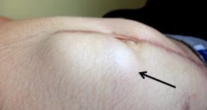 incisional hernia swelling