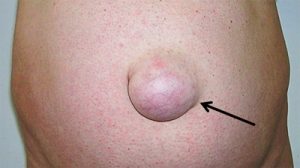 Supra umbilical hernia : r/Hernia