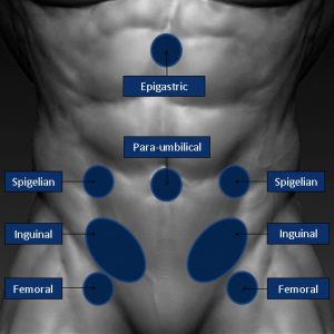 Types Of Hernias Diagram