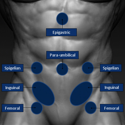 Types Of Hernia The Hernia Clinic